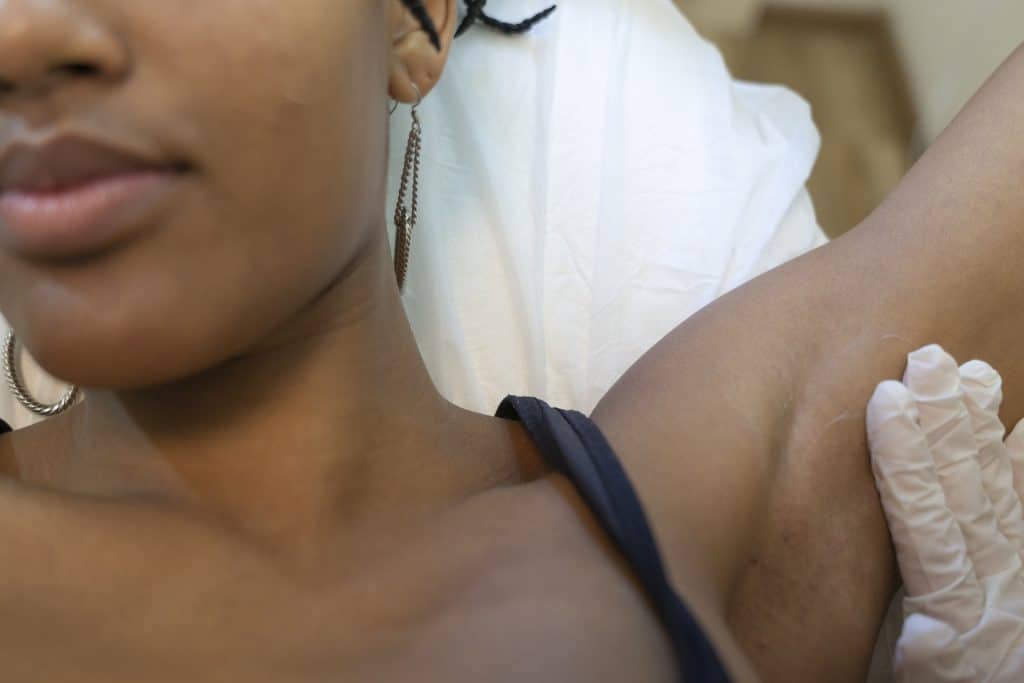 hair removal
